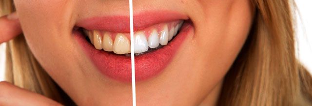 Blanchiment des dents.